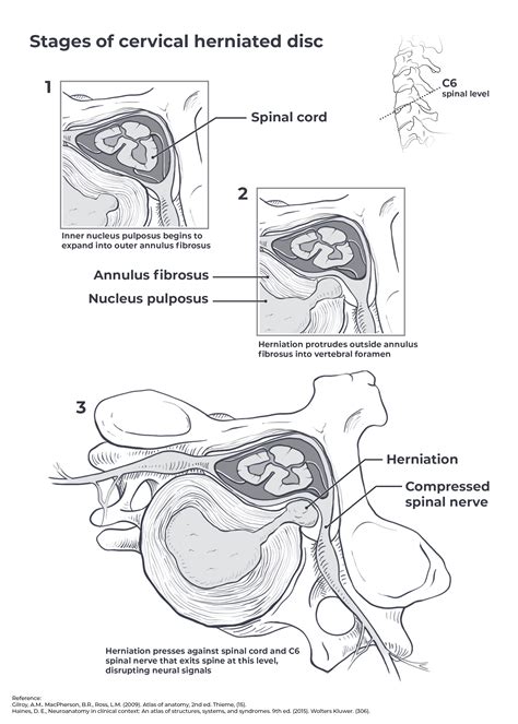 Stages of cervical herniated disc — Eleanor Milman