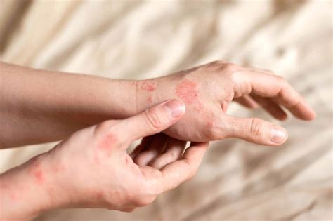 Démangeaison Main Boutons Ou Plaques Rouges Quels Remèdes