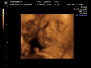 4D scan | We got a 4D scan today of our unborn daughter. | Thomas ...