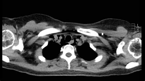 Spontaneous Pneumomediastinum: Hamman Syndrome - JETem