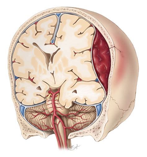 Epidural Hematoma The Neurosurgical Atlas