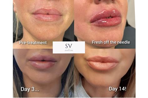 Lip Filler Manchester Sv Aesthetic Clinic