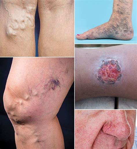 Vein Diseases And Treatments Dr Andrey Espinoza