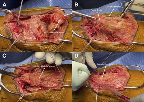Double-Row Suture Anchor Fixation and Achilles Allograft Augmentation