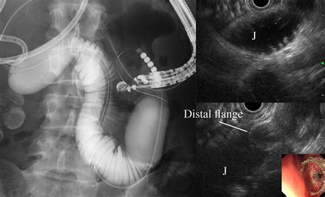 Technical Review Of Endoscopic Ultrasonography‐guided Gastroenterostomy