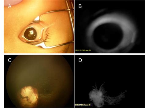 Figure 3 From A Case Of Retinoblastoma Resulting In Phthisis Bulbi