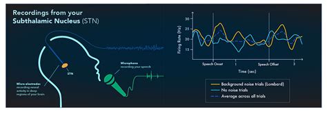Integrating Patient Perspectives into Intracranial Research | Brain ...