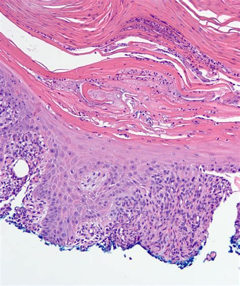 Keratoacanthoma Histology Multiple Self Healing Squamous Epithelioma