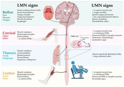 The Stages Of Amyotrophic Lateral Sclerosis (ALS) ALS News, 56% OFF