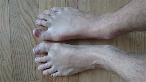 Pain while running (hallux valgus) : r/FootFunction