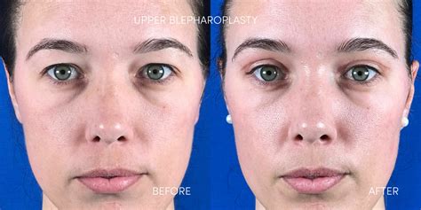 5 Of The Best Eyelid Rejuvenation Options And Their Results Dr Nerina Wilkinson Associates