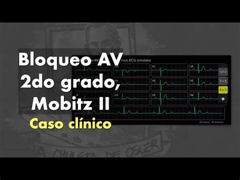 Caso clínico Bloqueo AV de 2do grado Mobitz II YouTube