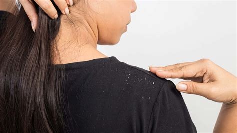 How To Use Baking Soda On Dandruff To Get Rid Fast Guide