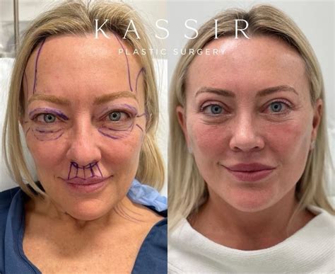 Before And After Facelifts All Healing Stages And Tips For A Quick