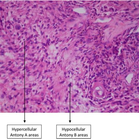 Microscopic Histopathologic Photographs Of Biopsy Specimen Showing