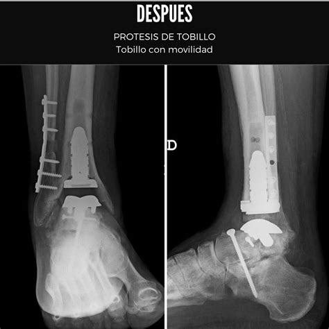 Retirada De Artrodesis De Tobillo Los Mejores Especialistas En