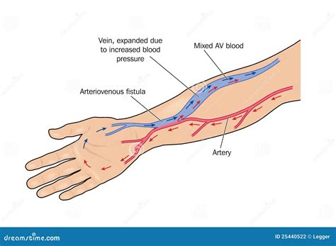 Dialysis Fistula Diagram