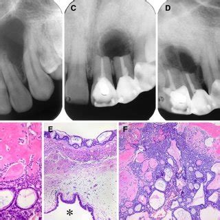 Primary Intraosseous Squamous Cell Carcinoma A Panoramic Radiograph