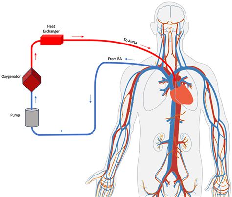 Vv Ecmo Circuit