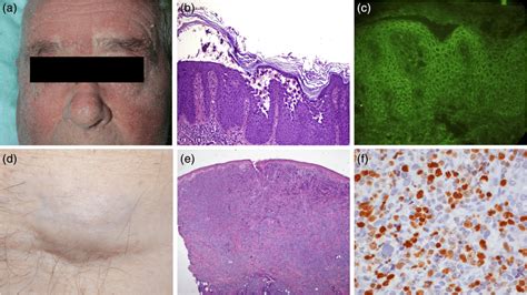 Diffuse Psoriasiform Dermatitis On The Face Of The 86‐year‐old Male