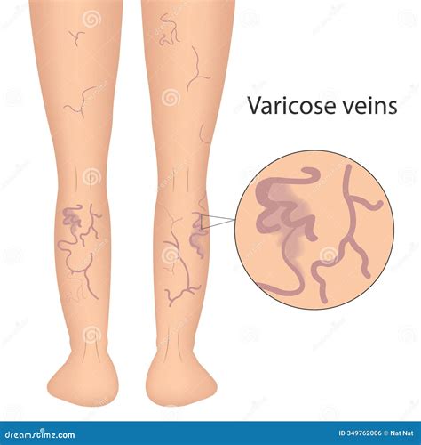 The External Sign of Dilated Skin Vessels. Symptoms of Vascular Lesions