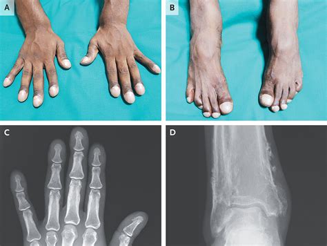 Primary Hypertrophic Osteoarthropathy | New England Journal of Medicine