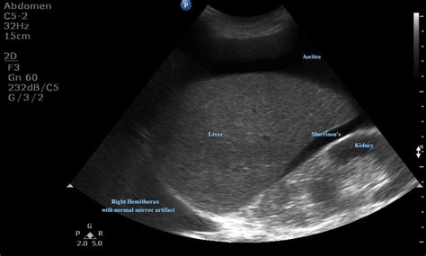 Ultrasound Guided Paracentesis Emory School Of Medicine