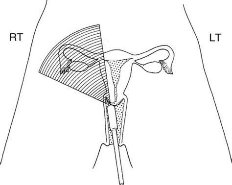 Transvaginal Scanning Protocol For The Female Pelvis Radiology Key