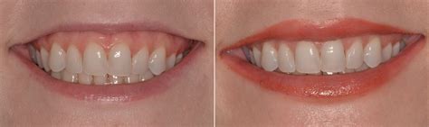 Gummy Smile Correction Photos Miami Patient 9713