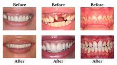 Post Malones Teeth Before And After