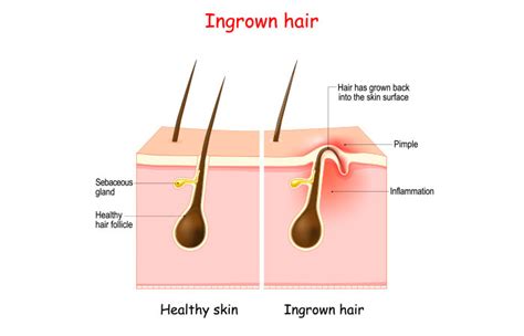 Ingrown Hair Scars: Causes, How To Treat, & Prevention Tips