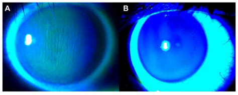 Jcm Free Full Text Clinical Significance Of Corneal Striae In