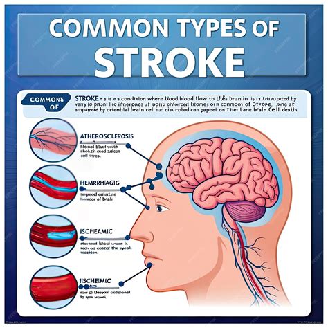 Informative Poster on Common Types of Stroke | Premium AI-generated image