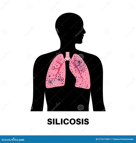 Silicosis Dust In Lung Cartoon Vector | CartoonDealer.com #278960209