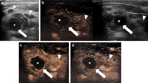 Severe Right Side Lymphadenitis Colli In A 5 Year Old Girl A