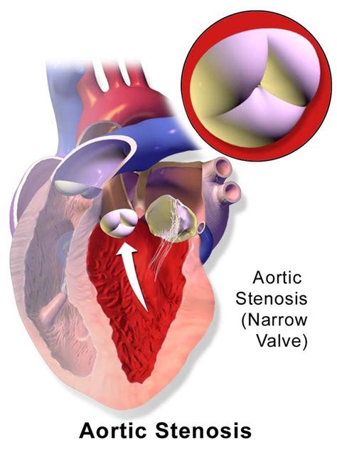 Aortic Valve Disease patients can go for THV Therapies now | Searcy Law