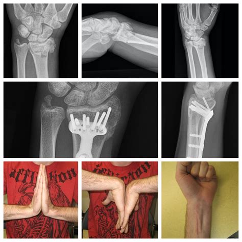 Radius And Fracture At Ruben Lambert Blog