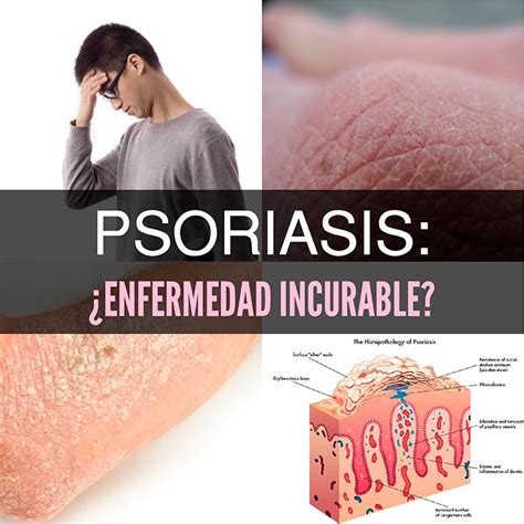 Psoriasis Qu Es Causas S Ntomas Y Tratamiento La Gu A De Las