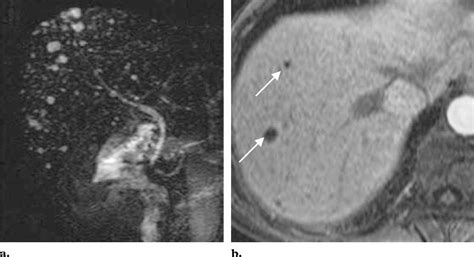 Biliary Hamartoma Coronal Mr Cholangiopancreaticogram A And Axial