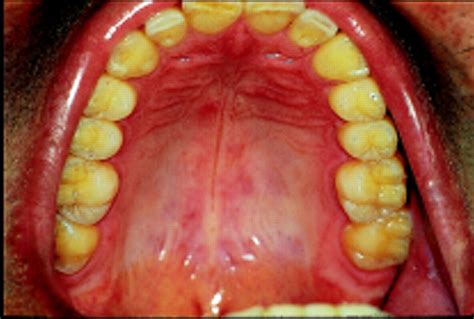 Oral Health And Disease The Bmj