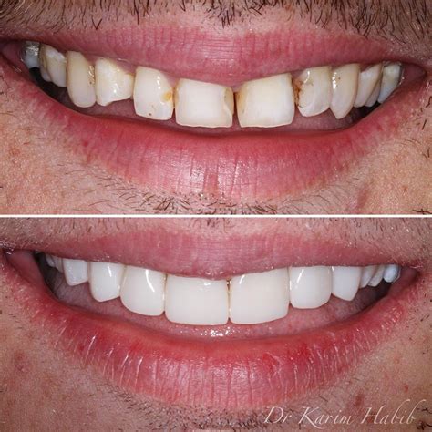 Composite Veneers Sydney | Dental Bonding Sydney - Dentist Ryde ...