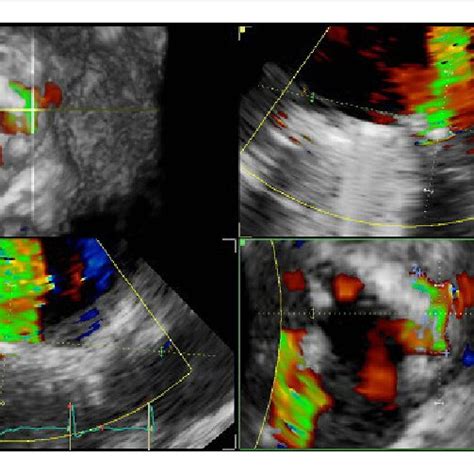 Three Dimensional Transesophageal Echocardiography Demonstrating