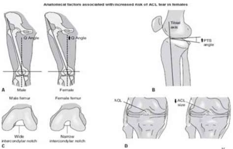 Predicting Anterior Cruciate Ligament Injuries In Knee The Protector