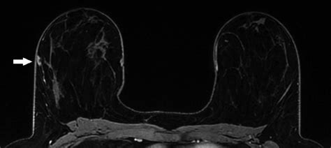 Axial T1 Weighted Fat Saturated Postcontrast Mri Demonstrates A