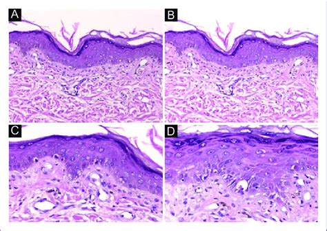 A B Epidermis With Poikilodermal Changes C D In The Papillary And