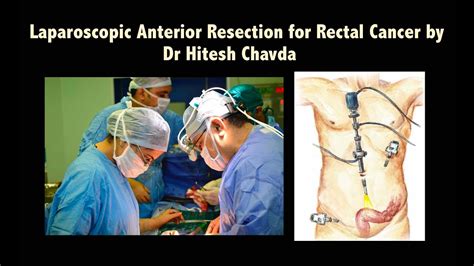 Laparoscopic Anterior Resection For Neuroendocrine Tumor Of Rectum By