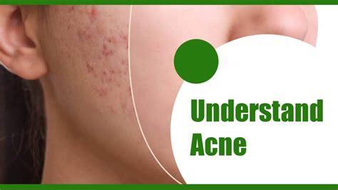 How To Get Rid Of Acne 💊 Generic Seva