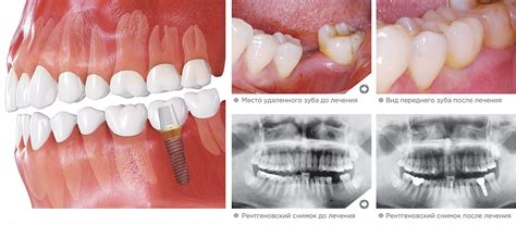 Клинические случаи имплантации