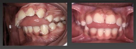 Etiology Of Malocclusion Flashcards Quizlet