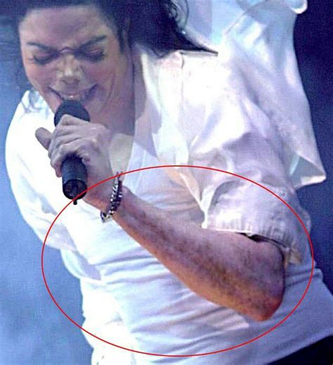 Vitiligo Michael Jackson Proof